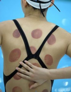 Dreamclinic Massage Cupping