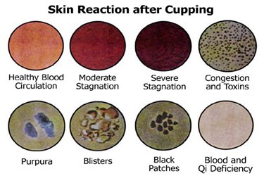 Skin Reaction After Cupping