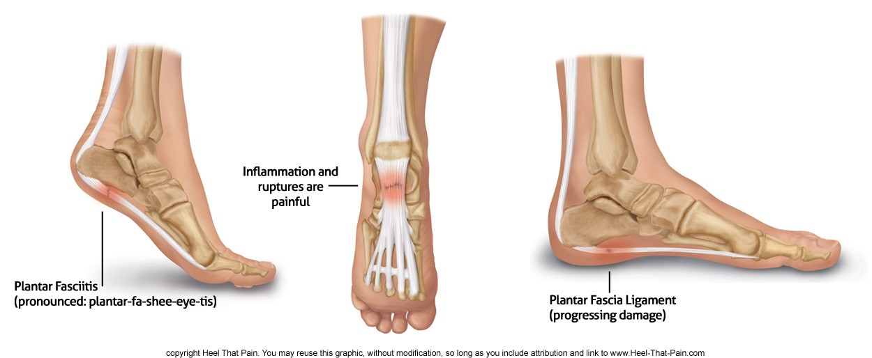 Do I have Plantar Fasciitis or Heel Pain? - KC Foot Care