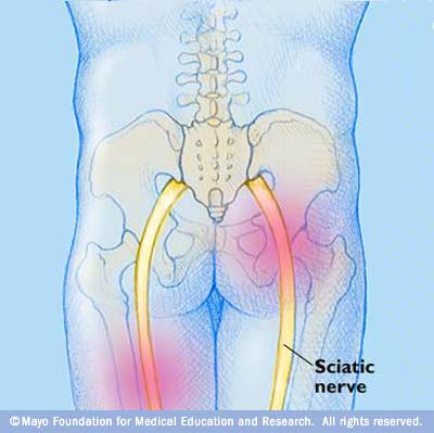 How to Treat Sciatic Nerve with Massage 