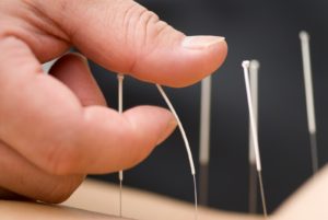 Wie fühlt sich Akupunktur an? dreamclinic acupuncture bellevue redmond seattle