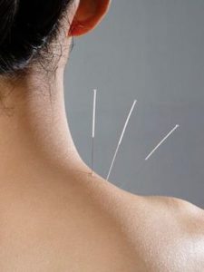 5 reasons to try acupuncture, Acupuncture at Dreamclinic massage and wellness Seattle and Redmond