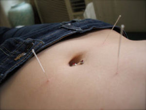 Acupuncture for constipation, Redmond Acupuncture, Bellevue Acupuncture