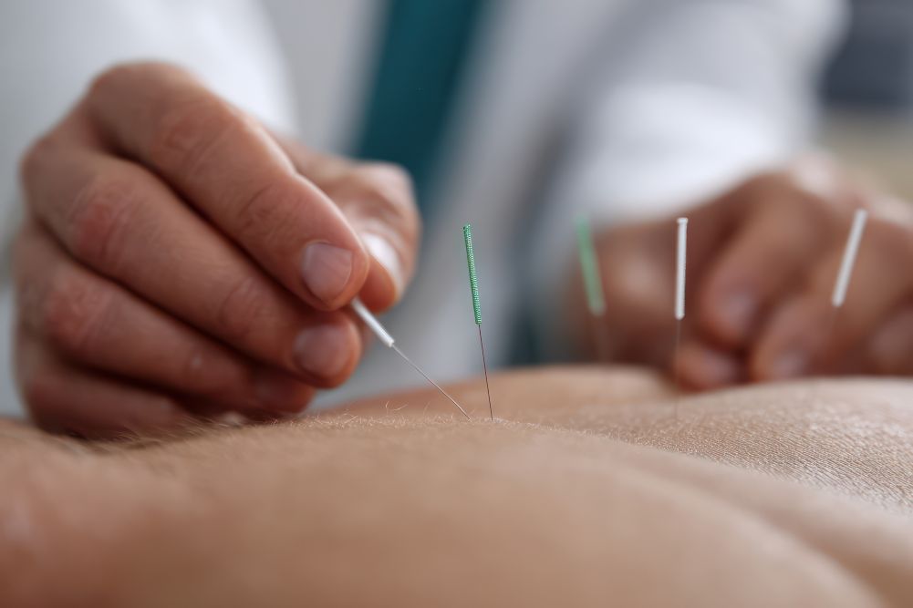 Acupuncture for Migraines and Tension Headaches